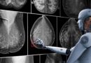 Una IA australiana predice el riesgo de cáncer de mama incluso tras mamografías normales