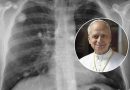 León XIV es operado de un adenocarcinoma, un tipo de cáncer de pulmón